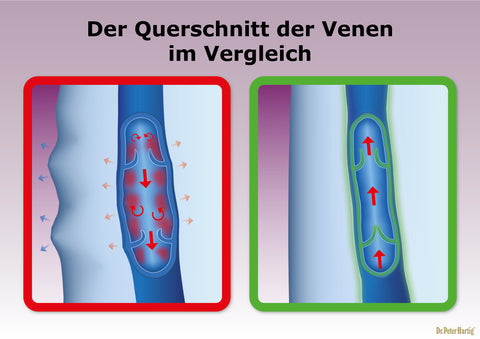 VenoStar Ermäßigte Mehrwertsteuer Dr. Peter Hartig